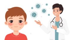 Kasus Campak Ditemukan di Beberapa Wilayah, Masyarakat Diminta Kenali Gejala dan Cara Penanganannya